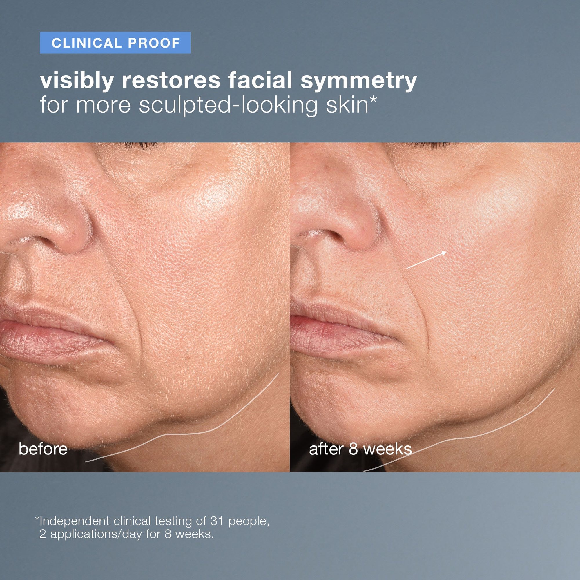 Before and after facial comparison showing improved skin symmetry and definition after 8 weeks